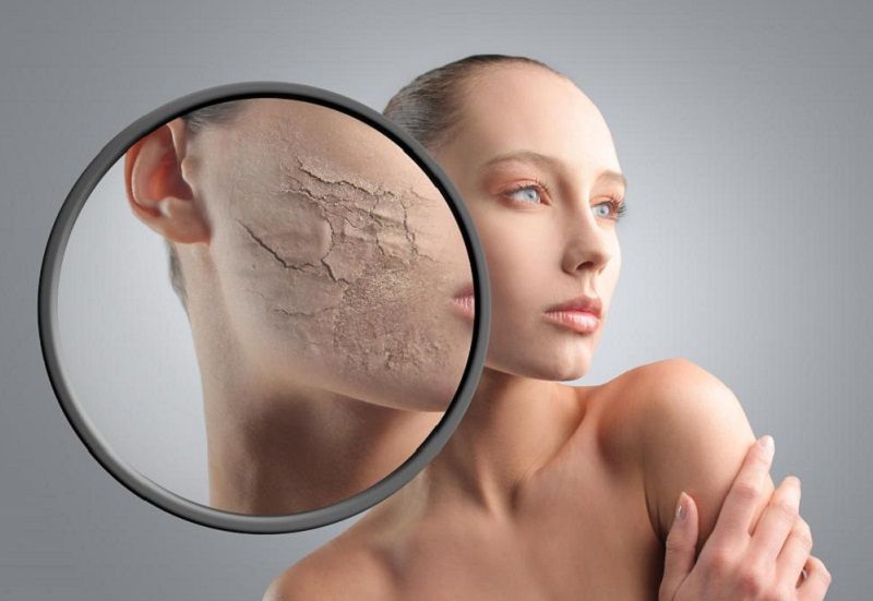 Кожа сохнет и шелушится? Пять способов избавиться от проблемы